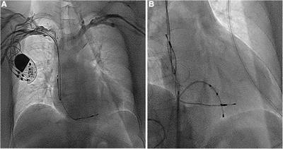 Case report: Unusual cause of refractory hypoxemia after pacemaker lead extraction